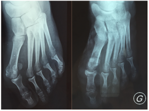 Hallux Valgus Percutane Chirurgie Orthop Dique Sainte Marie